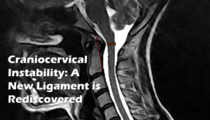 instability craniocervical ligament cervical centenoschultz