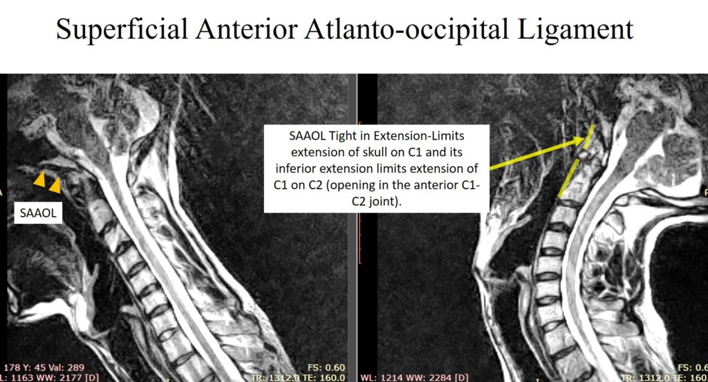 craniocervical instability ligaments
