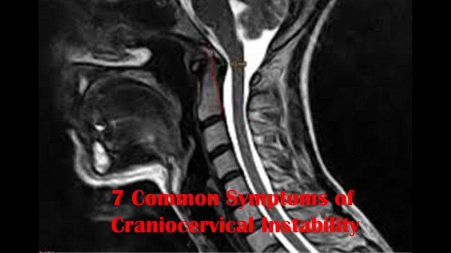 craniocervical instability symptoms