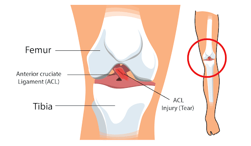 How to Spot and Treat an ACL Tear