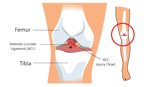 Passive to Active Protocol Progression for MCL Partial Tear