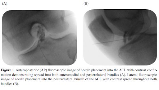 ACL Ruptured - All You Need to Know - Centeno-Schultz Clinic