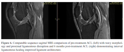 ACL Ruptured - All You Need to Know - Centeno-Schultz Clinic