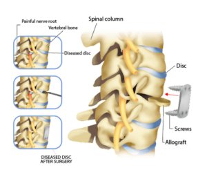 Anterior Cervical Discectomy And Fusion – What To Know