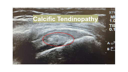 Rotator Cuff Tear  Orthopedic Doctors in Greater Grand Rapids, MI