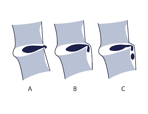 Cervical herniated disc clearance pillow