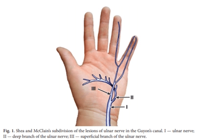 Ulnar Nerve Compression in Guyon's Canal