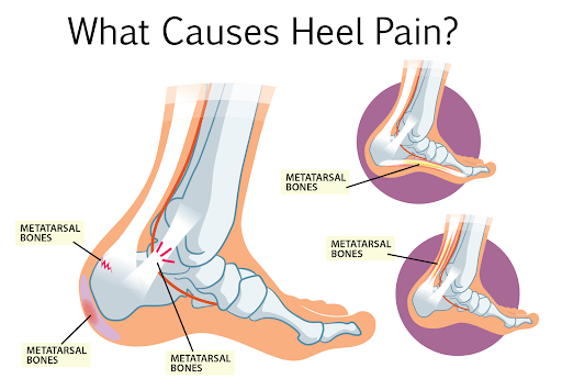 Foot pain near on sale heel