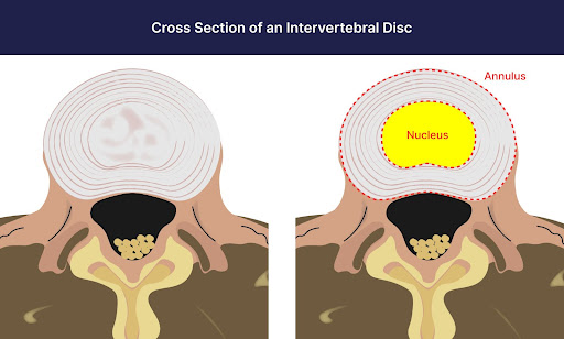 Causes of a “Crackling” Sound in the Neck - Inspired Spine