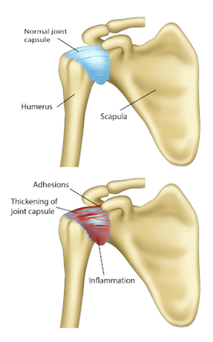 Understanding Causes And Symptoms Of Frozen Shoulder