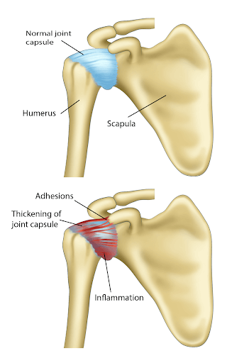 Why Is My Shoulder Pain Worse at Night?  Orthopaedic Associates of Central  Maryland