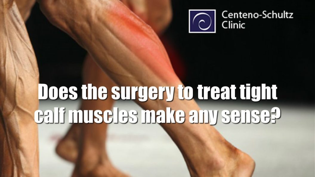 gastrocnemius recession surgery to lengthen a tight calf muscle