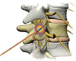 https://centenoschultz.com/wp-content/uploads/csc-how-radiofrequency-ablation-works.png