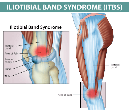 Partial tear of the proximal iliotibial band (ITB) resulting in