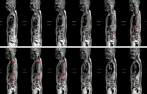 lesions on mri t spine