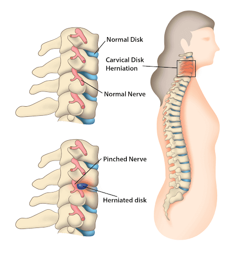 Pinched Nerve (Cervical Radiculopathy)