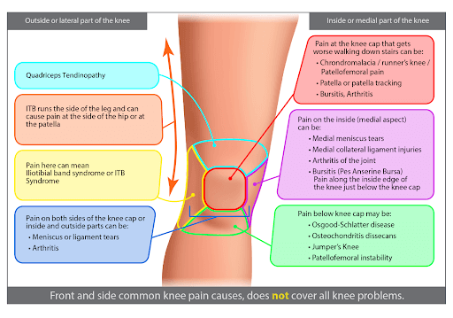 Knee Pain Location Chart: Diagnose Your Knee Pain