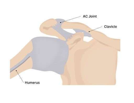 Shoulder Arthritis: Causes, Symptoms, And Treatment