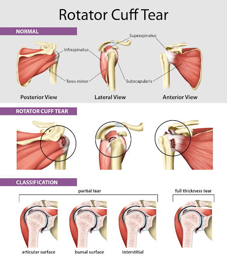 Partially Torn Rotator Cuff  Fracture And Orthopaedic Clinic Limited