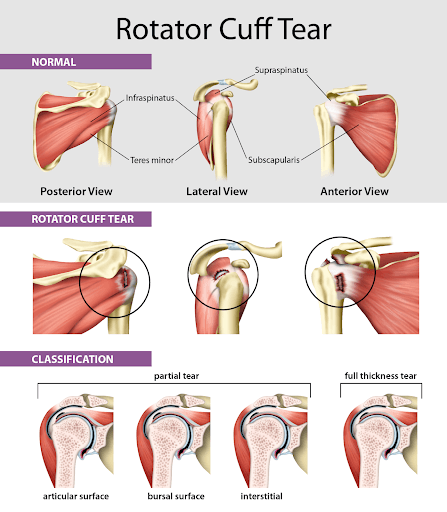 Rotator Cuff Tear - Symptoms and Treatments - Total Spine