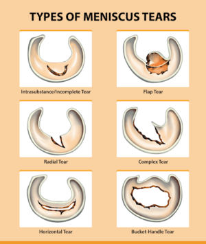 Meniscus Tears: Everything You Need to Know – Centeno-Schultz