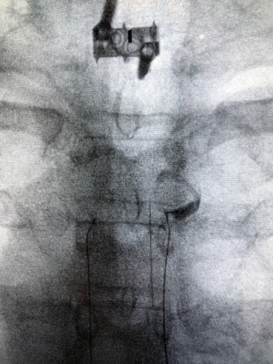 Thoracic Spine Facet Irritation