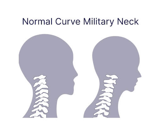 Straight Neck - All You Need To Know - Centeno-Schultz Clinic