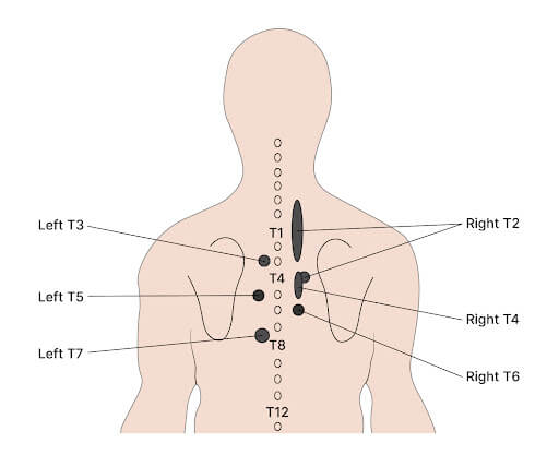 Back, chest and abdominal pain - is it spinal referred pain