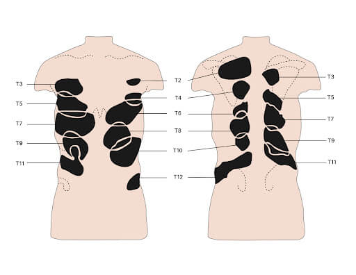 Back, chest and abdominal pain - is it spinal referred pain