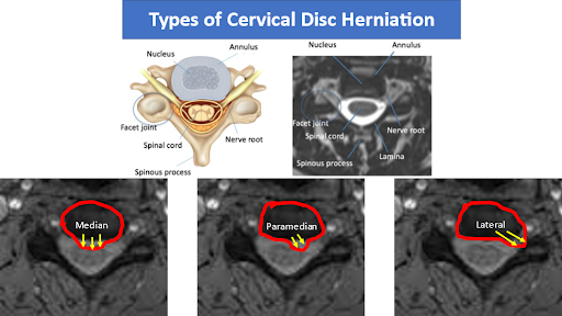 Cervical Herniated Disc Causes and Diagnosis