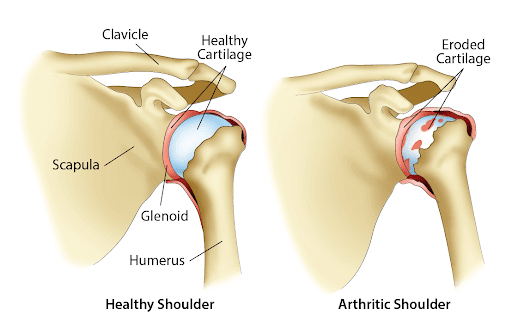 Physical Therapy in Baker County for Shoulder - Rotator Cuff Tears