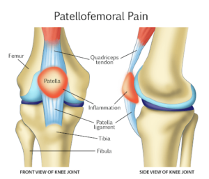 Patellofemoral Pain Syndrome – Everything You Need to Know