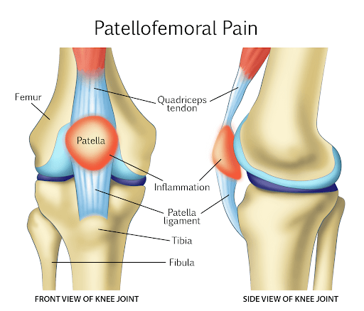 The J-sign, known as the lateral patellar tracking on anterior