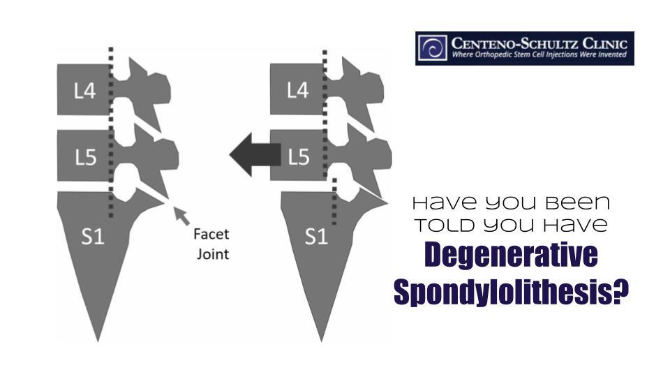 degenerative spondylolisthesis