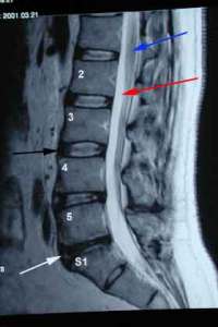 Degeneration of lumbar spine