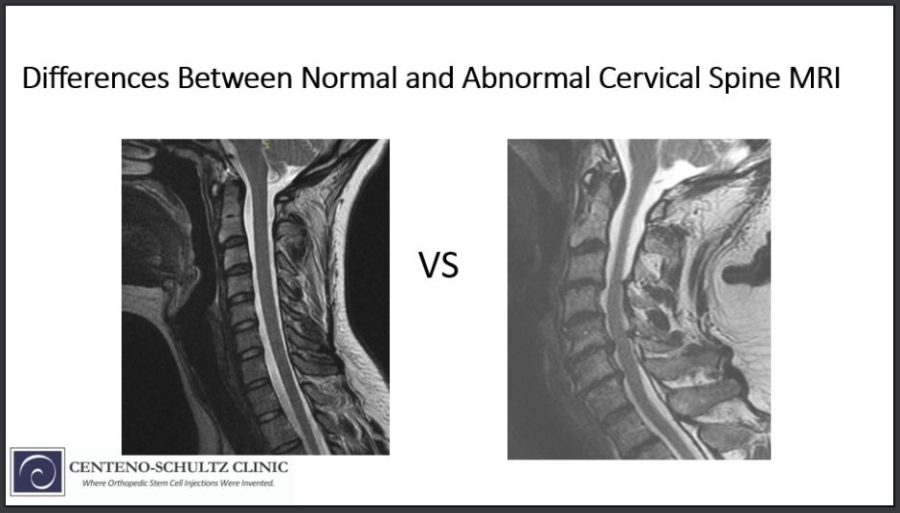 Differences Between A Normal Vs Abnormal Cervical Spine Mri 7269