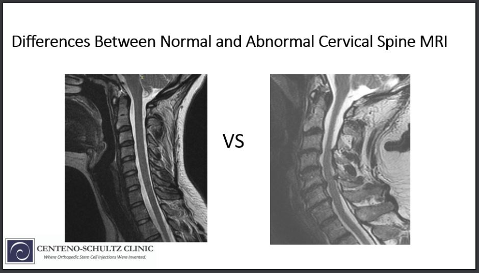 Differences Between A Normal Vs Abnormal Cervical Spine Mri Neck R My