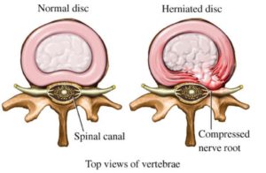 annular ligament spine