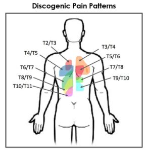 Thoracic Discogenic Pain Diagram - how herniated thoracic disc affects nervous system.