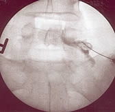 epidural-injection-unders-x-ray