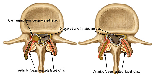 facet cyst on facet joint