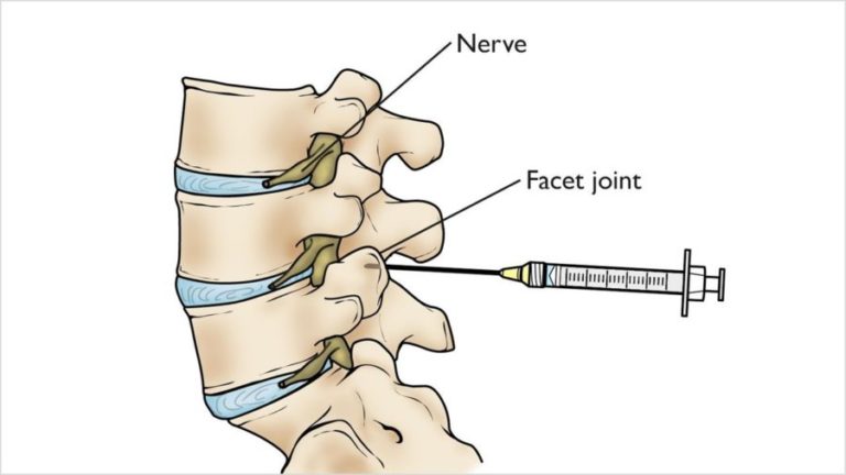 What Is A Facet Joint Injection Centeno Schultz Clinic 3027