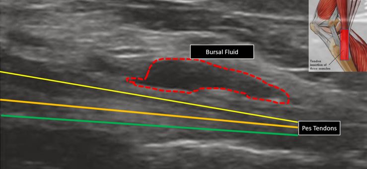 Pes Anserine Ultrasound