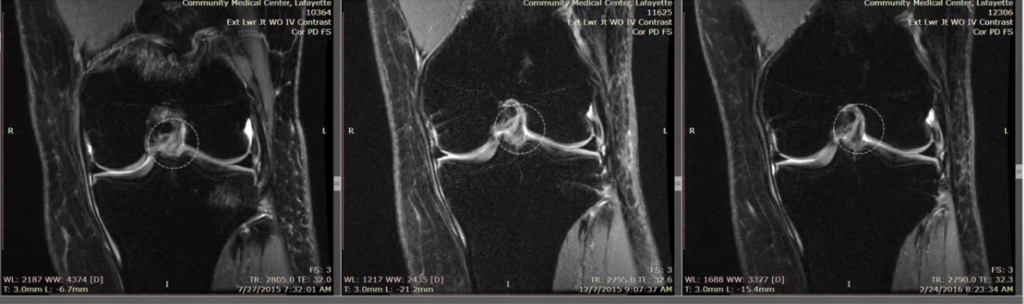 Front of ACL in MRI