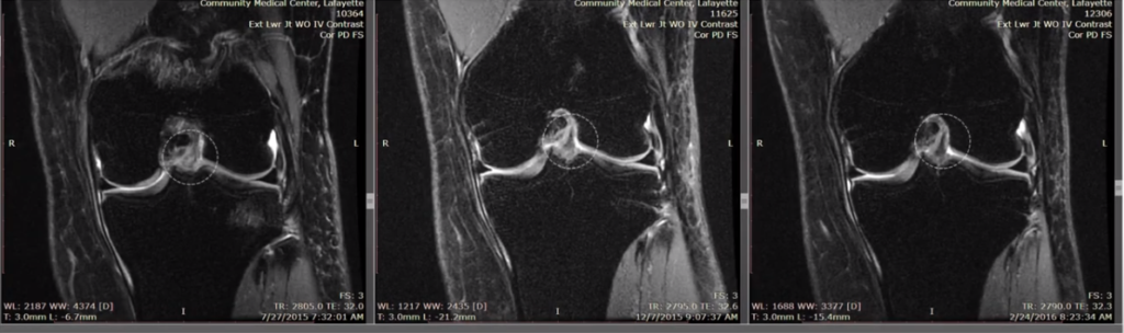 ACL Ruptured - All You Need to Know - Centeno-Schultz Clinic