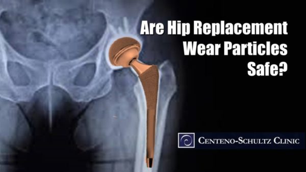 Hip Replacement: Why You Should Be Concerned Wear Particles?