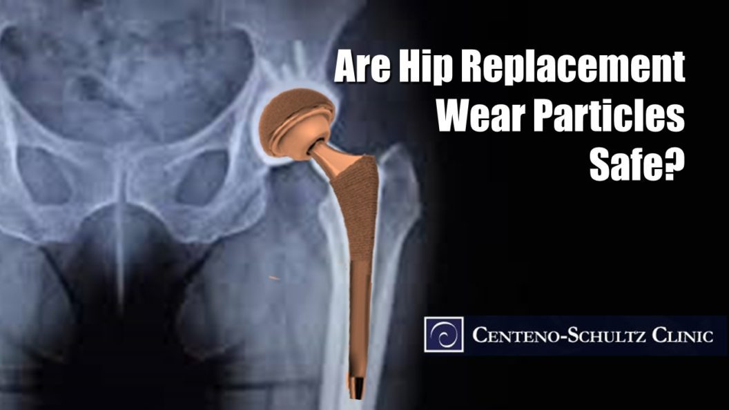 hip replacement wear particles