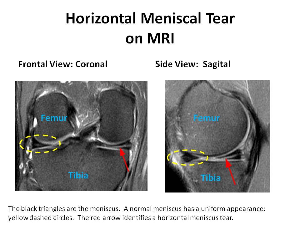 0 Result Images of Types Of Meniscus Tears Mri - PNG Image Collection