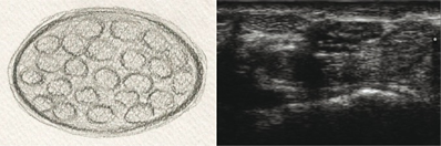 Guyon's canal treatment through nerve hydrodissection.