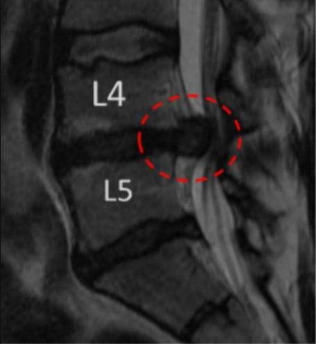 Before MRI - Perc-FSU - The Trusted Alternative to Spinal Fusion